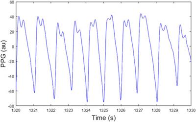 Photoplethysmogram beat detection using Symmetric Projection Attractor Reconstruction